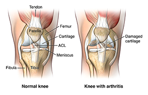 A normal knee and a knee with arthritis